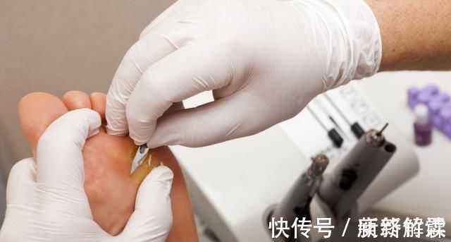 脚掌|脚上出现这三种信号,肝脏或许早已“烂如筛网”,请尽早检查