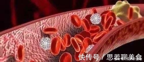 血栓|血管堵塞了这4物胜过“阿司匹林”,用来泡水喝,轻松消血栓