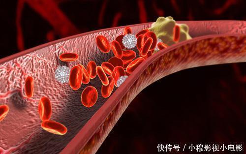 医生|多走路可以降血脂?心血管医生:过了50岁,做好3件事或更有效
