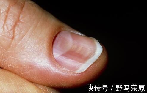 绿脓杆菌|指甲出现这些变化, 它在暗示你的身体里有病!