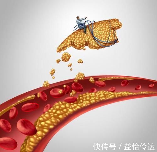 胰岛素|二甲双胍,降糖降脂降体重,改善脂肪肝,保护心血管,降低肿瘤风险