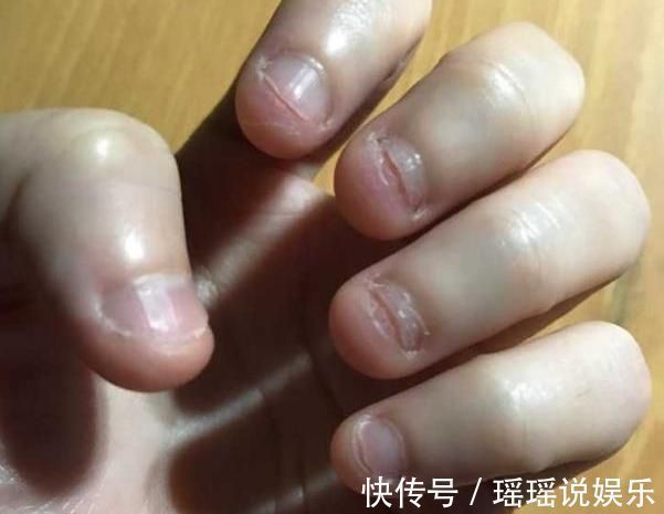 指甲垢|研究发现:爱咬指甲的孩子,都逃不过这5种结局!