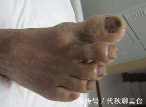 症状|无论男女,脚部出现4种异常,可能是糖尿病的早期症状,别忽视
