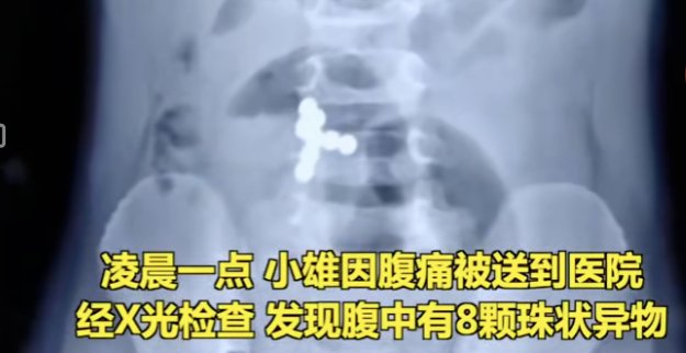 男童误吞8颗磁力珠导致肠穿孔！市场监管总局最新提示：慎买这3类儿童产品