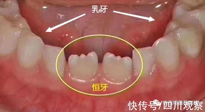 门牙|过年回家被人说孩子牙齿长丑了要箍？华西口腔专家教你辨别