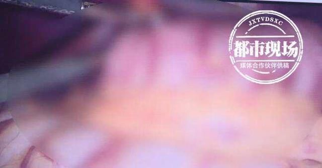 胃镜|头皮发麻14岁女孩胃里塞满这些,这个可怕的习惯她保持了十年