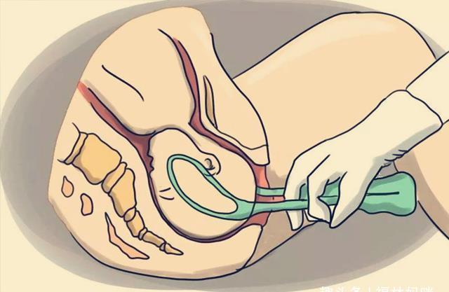 自然分娩|“大夫，我能换个姿势吗？”宝妈这句话，为宝宝免去“产钳”之苦