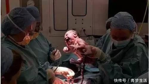 预产期|超预产期5周,准妈还在家“待产养胎”,取出孩子后医生无奈摇头