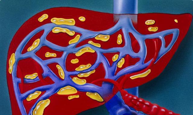 肝硬化|49岁男子，从肝硬化到肝功正常，常吃1红，肝脏慢慢恢复“柔软”