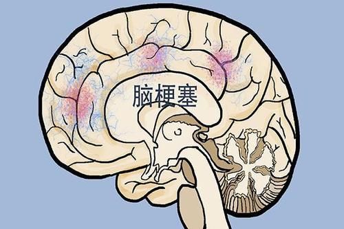 脑梗来临前,身体会发出哪些信号?千万不要忽视!