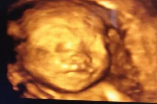 四维|孕期胎儿的四维图像,就是出生时候的模样?别急,后面可能有惊喜