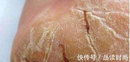 脚丫子|秋冬干燥脚开裂,婆婆教我一小方法,脚丫子又白又嫩