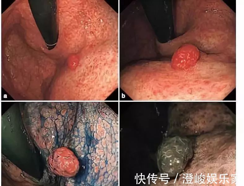 切除|大家好!我叫“息肉”,癌症的近亲!我最怕无情又温柔的手术刀艾灸