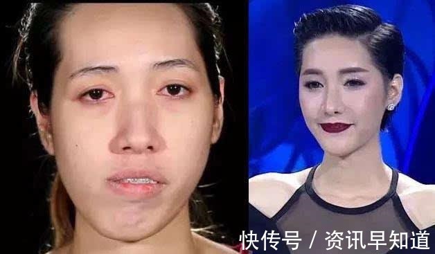 畸形|女子面部畸形像“丑八怪”, 整容后, 成为一名漂亮的女模特