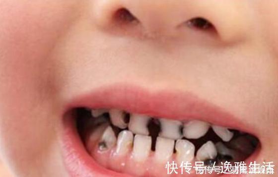 龋齿|四岁宝宝满口“黑牙”,罪魁祸首不是糖果,而是家长的放纵