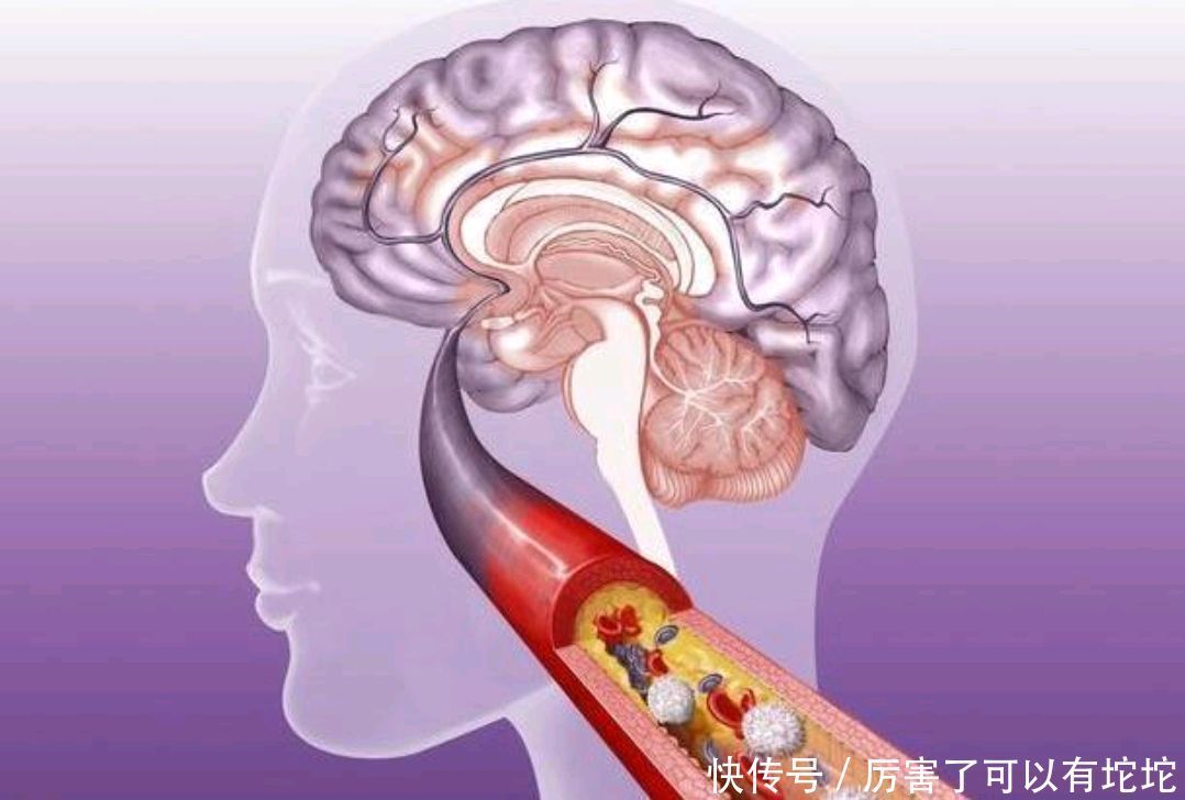 营养物质|胆固醇过高容易得脑梗?尽量少吃这5种食物，或许能慢慢降血脂