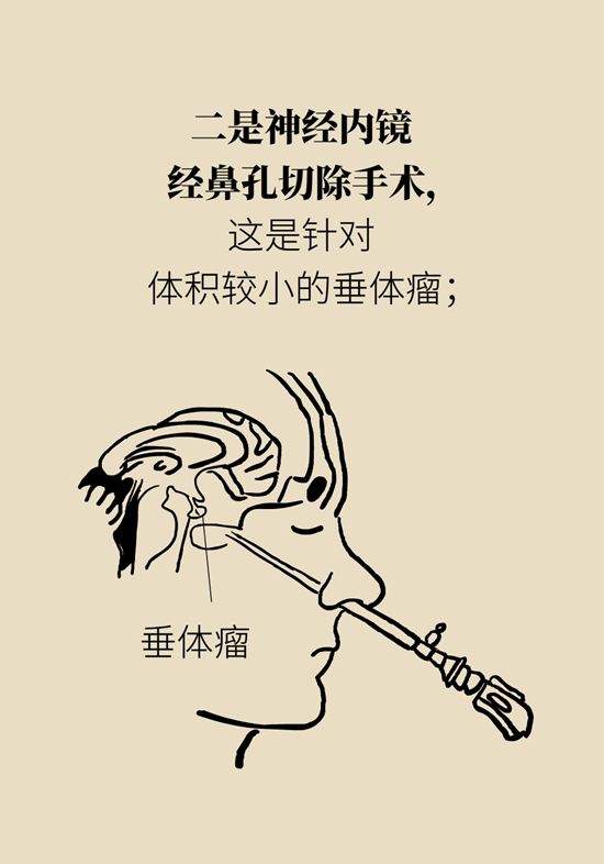 内分泌失调|变丑、变胖、内分泌失调……这些糟心事警惕脑肿瘤