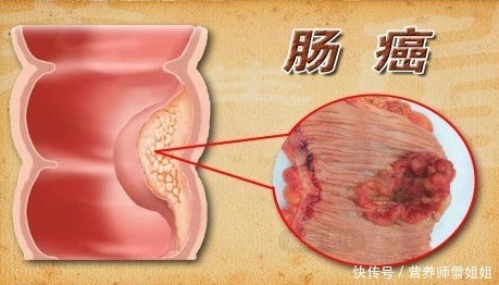 厕所|17岁男孩,一天跑8次厕所,医生分析诱因,一种肉吃太多惹的祸