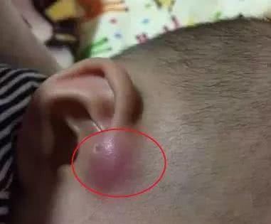 新妈妈|宝宝耳朵有“聪明孔”,妈妈忍不住挤了一下,医生摇头动手术吧
