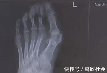 高跟鞋 爱穿高跟鞋的女性一定要小心,拇指外翻堪比“裹脚”!不可忽视