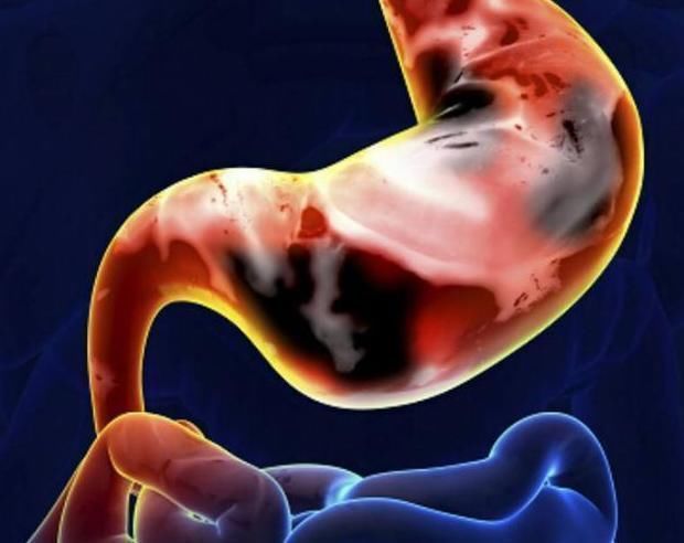 食物|养胃冠军已公布，不是小米粥，经常吃，灭幽门螺杆菌，胃或更舒坦