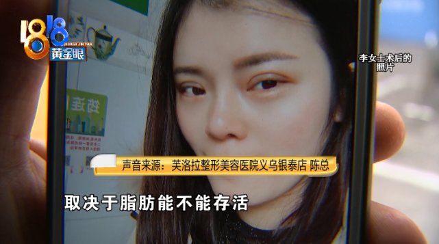 抽脂|女子130多斤，花3万多抽脂还是130多斤！医院：愿意提供二次调整