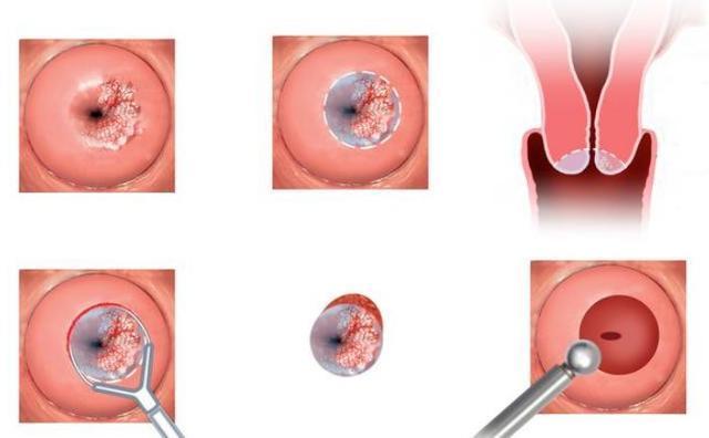 hpv|雙腿或是宮頸癌敲的“警鐘”，如出現以下3個異常，要及時查HPV