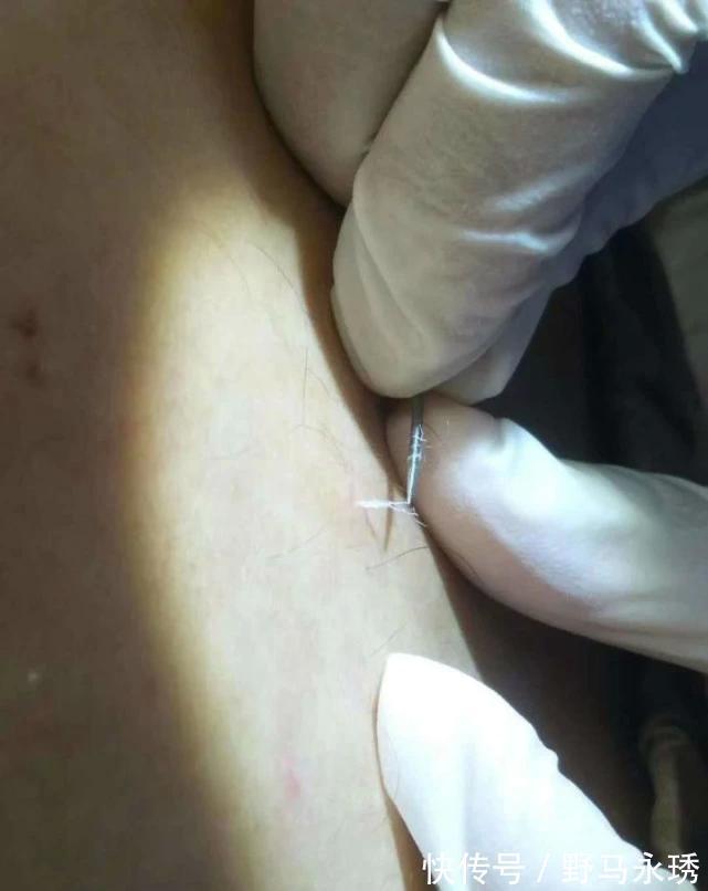 棉花丝|有痔疮的人,后腰常有“红色小点”,里面藏着“棉花丝”