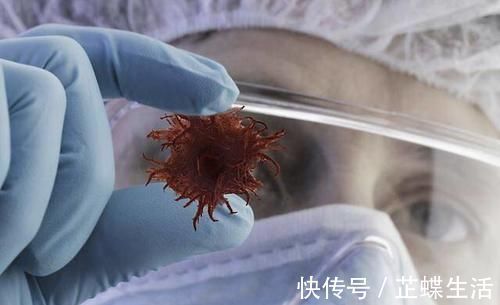 肿瘤细胞|良性肿瘤可以不用管吗？很多人都想错了，听专家讲良性与恶性肿瘤