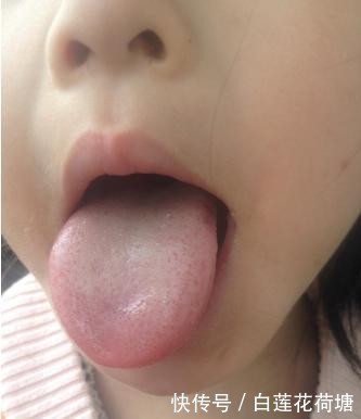 赶快|孩子有积食,发育会“慢半拍”,医生坦言:别吃药,赶快食疗