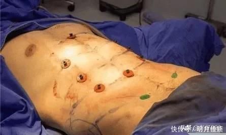 腹肌|24岁小伙通过手术雕出6块腹肌,恢复后像填棉絮的布偶,太吓人了