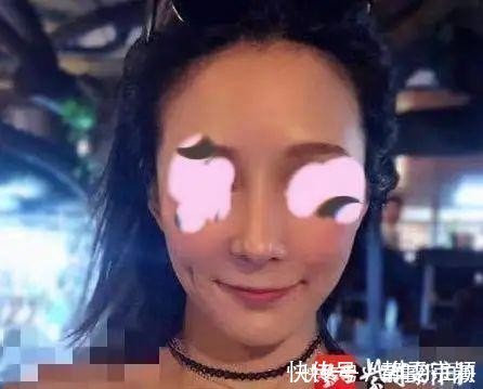 女子 女子整容后山根晃动、鼻尖发白!手术方:很成功,已起诉