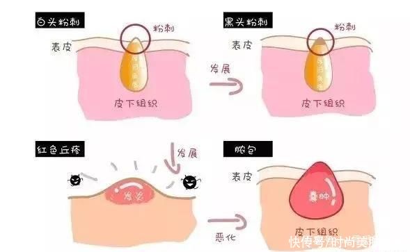 ME小科普:总是长痘痘怎么办?痘痘、闭口、粉刺你能分得清吗?