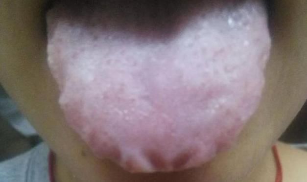 湿气重,难长寿,两个部位越来越大,说明你的湿气越来越重