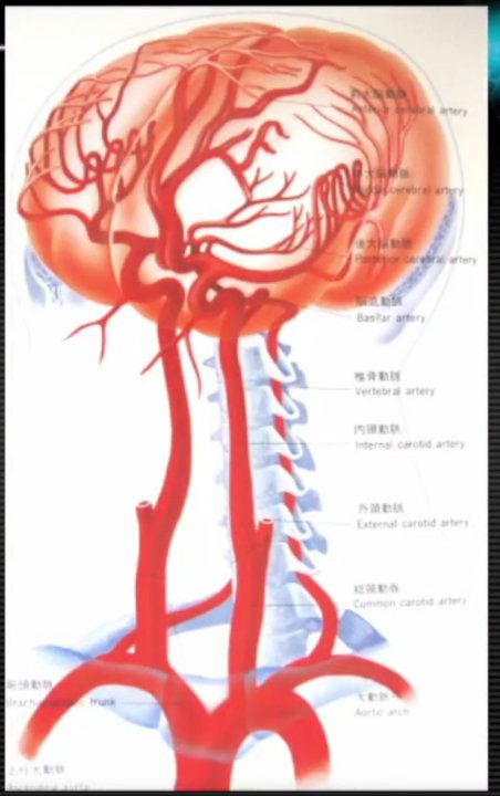 Anterior cerebral artery infarction, middle artery infarction...Super interpretation of clinical features of MRI