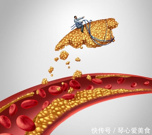 安全|高血脂天天吃他汀药,如何保证疗效和安全?提醒:这7点切莫忽略