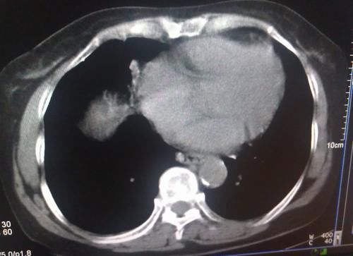 辣椒|肺结节患者不能吃辣椒？医生：要想肺部安稳，3种食物可多吃