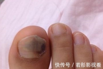 高血脂|血脂高不高，看脚就知道，若没有这4种症状，恭喜，血管还算通畅