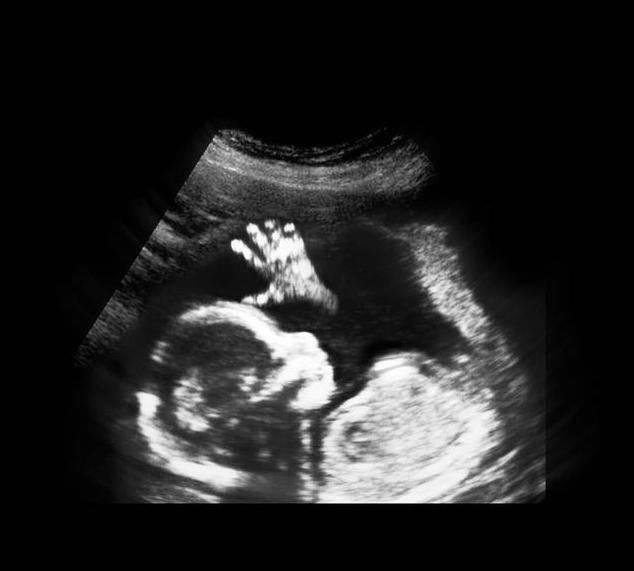 性别|胎儿从卵泡到性别形成,17张图片清晰诠释,男宝女宝看得很清楚