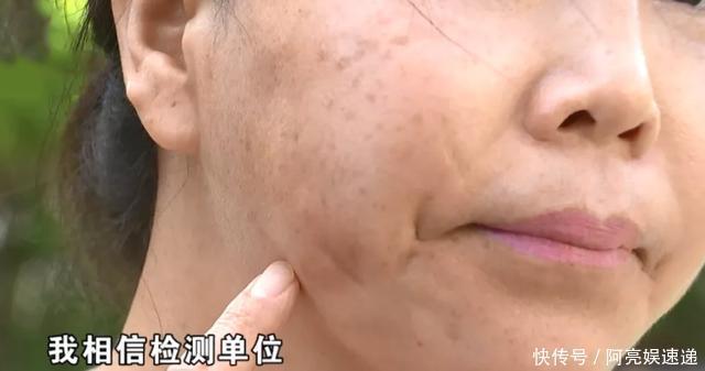 做完抽脂后，女子脸上多出两个鼓包，还因此失去两段“姻缘”