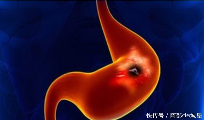 会出现|爱拖拉的人,当遇到这个“饭后表现”时,可能是“胃癌”的前兆