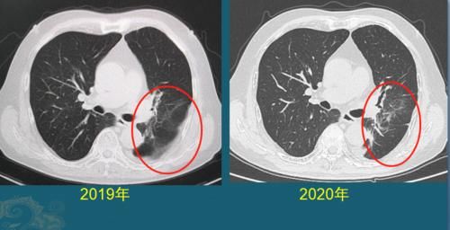  治愈的病|生存期长的癌症有哪些？医生用CT片举例，至少3类
