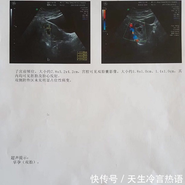 真的|强大的孕气真的会传染多囊的我喜获双胞胎，下一个好孕就是你