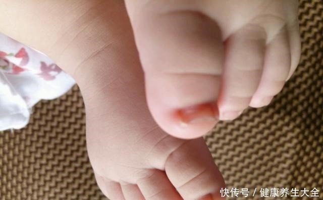 新潮|5岁女宝双脚变形,只因长期穿这鞋,选鞋“雷坑”很多妈妈还在犯!