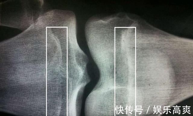 生长发育|孩子个子矮,是“矮小症”还是“发育晚”,用3个方法就能辨别!