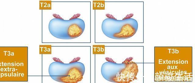 复发|为什么医生总是让癌症患者做CT检查？三大作用，你可能不了解