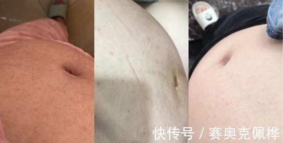 精华乳|妊娠纹只要长出来就是一辈子!拒绝“西瓜肚”辣妈分享去纹心经