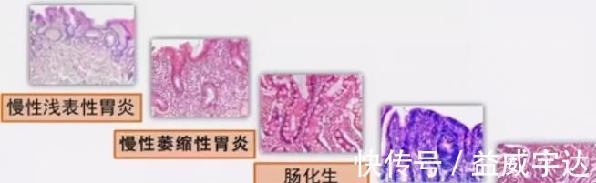 上皮内瘤变|胃镜查出来“上皮内瘤变”,是癌吗?该怎么办?