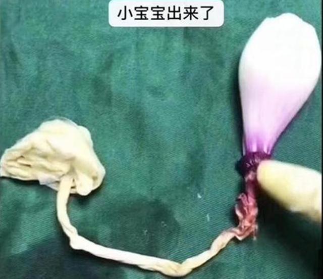 麻醉针|选剖腹产不疼这根10厘米的麻醉针仅仅是开始,疼到你怀疑人生