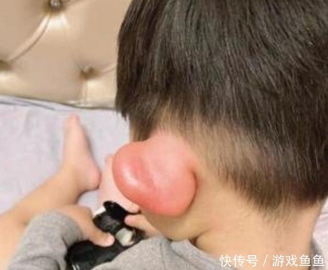 花露水|宝宝被蚊子咬成“大耳朵图图”,又疼又痒还留疤,怎么处理最好?